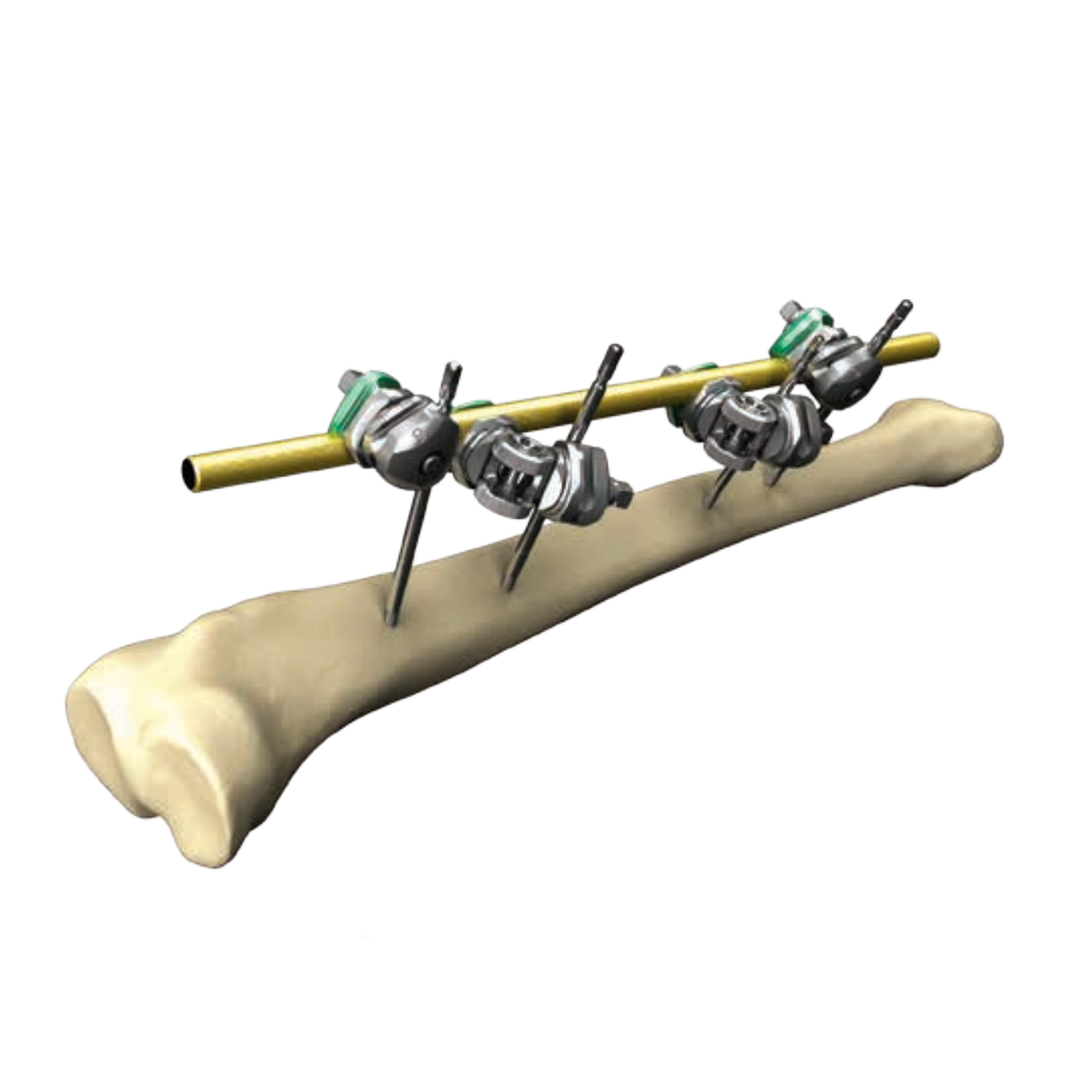 Hoffman 3 External Fixation | The Hoffmann 3 Modular External Fixation System is intended to provide stabilization of open and/or closed, stable or unstable fractures where soft tissue precludes the use of other fracture treatment methods.