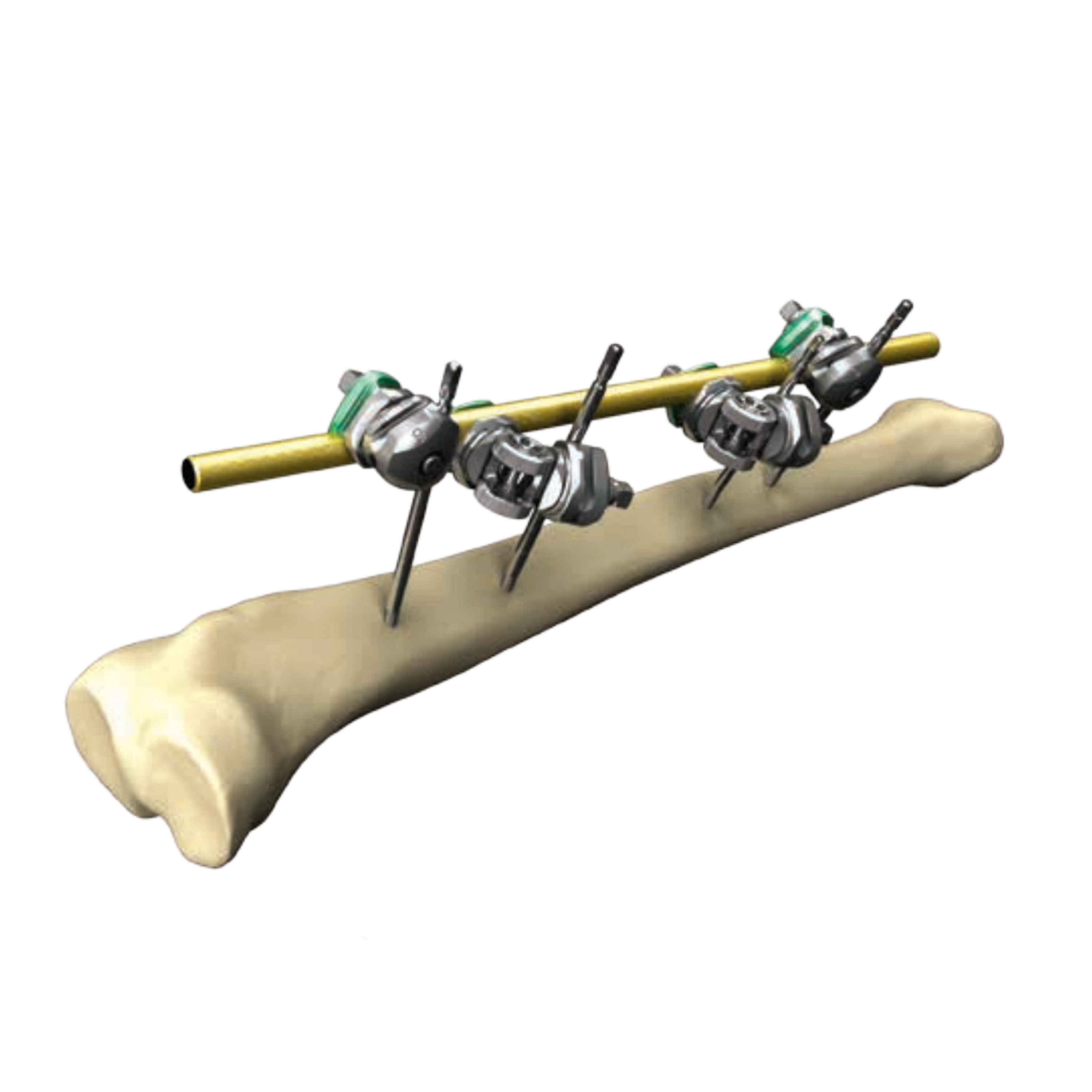 hoffman-3-external-fixation-joint-medical-products-caribbean-limited