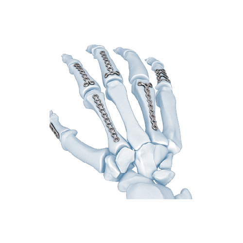 Profyle Modular System | The Profyle Hand System offers a comprehensive range of plates and screws to treat most phalangeal, metacarpal, and carpal fractures and disorders.