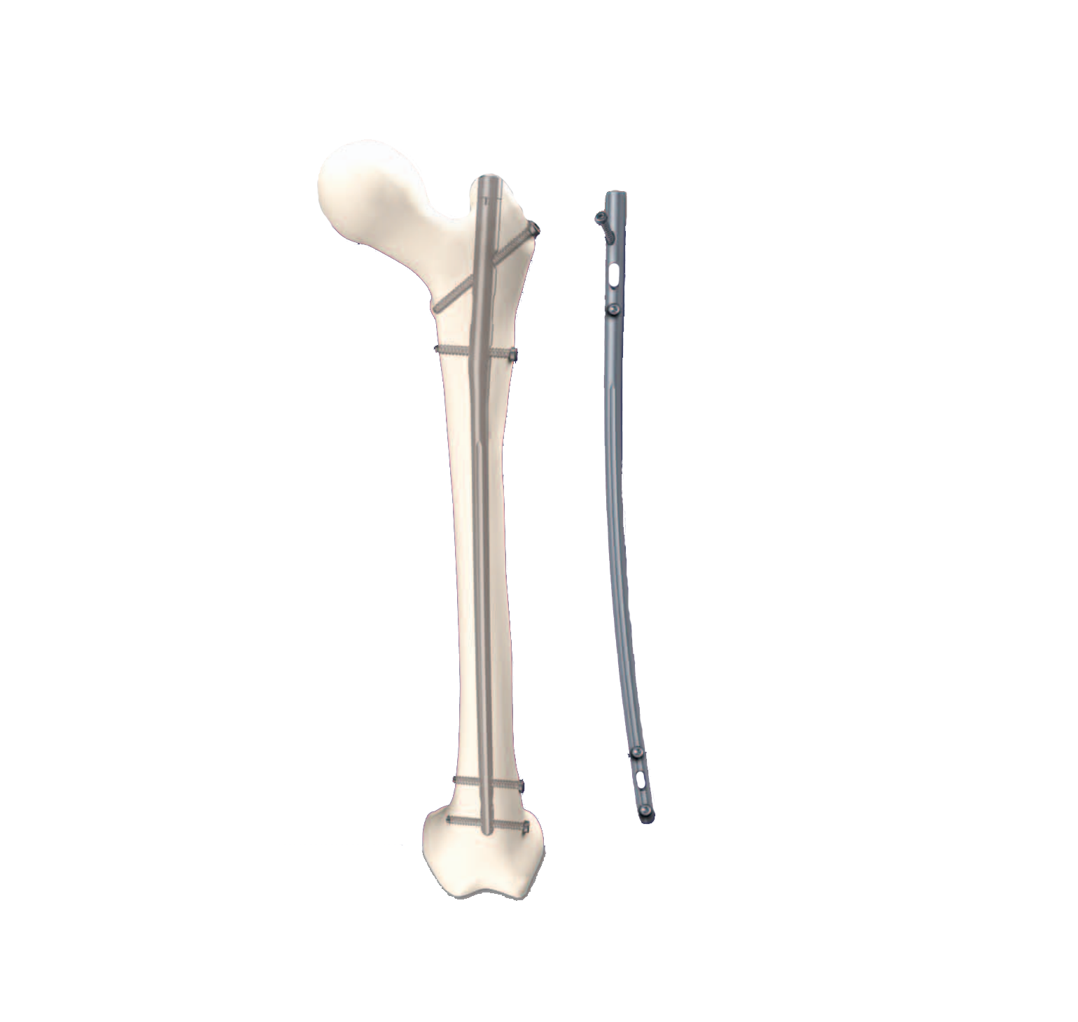 T2 Greater Trochanter Entry Nailing System | ​The T2 Greater Trochanter Entry Nailing (GTN) System is designed for the treatment of femoral shaft fractures.
